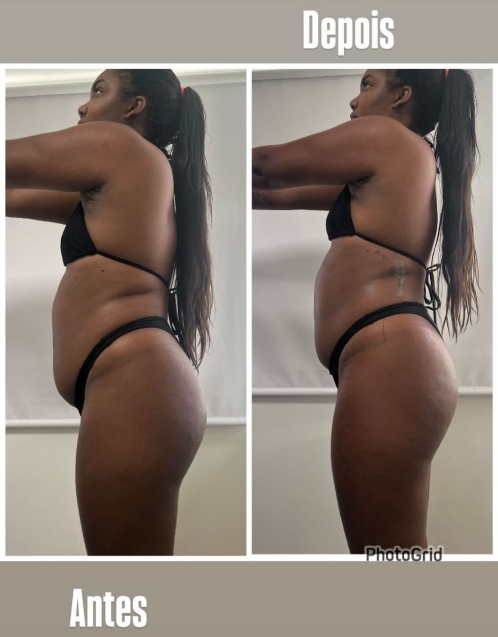 Raquel Brito mostra antes e depois de procedimento — Foto: Instagram
