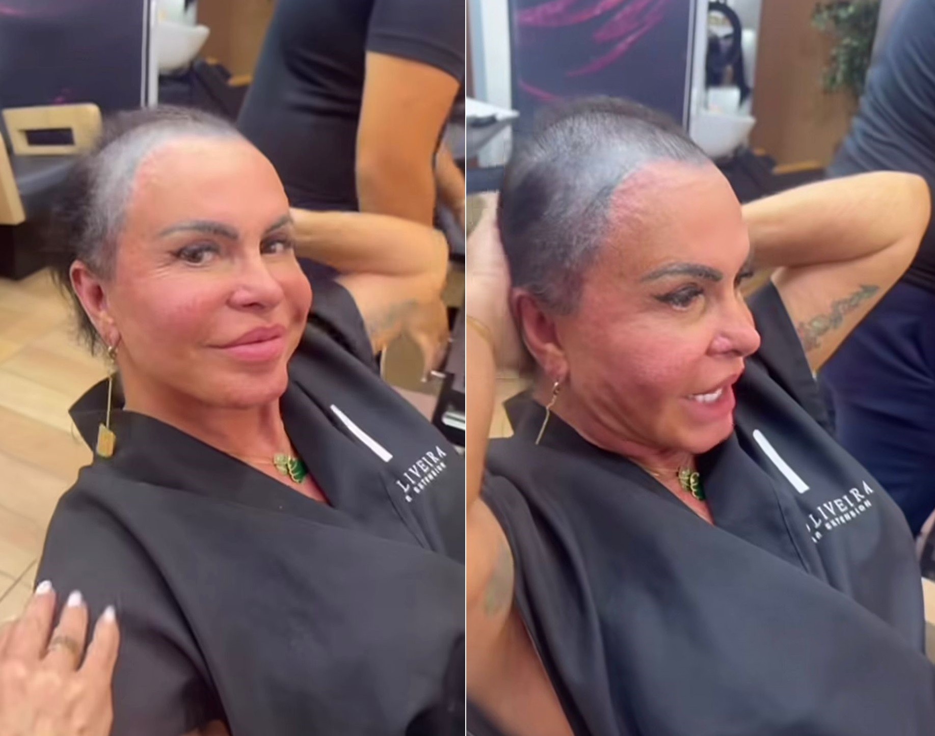 Gretchen revela tratamento contra alopecia e aparece sem prótese capilar