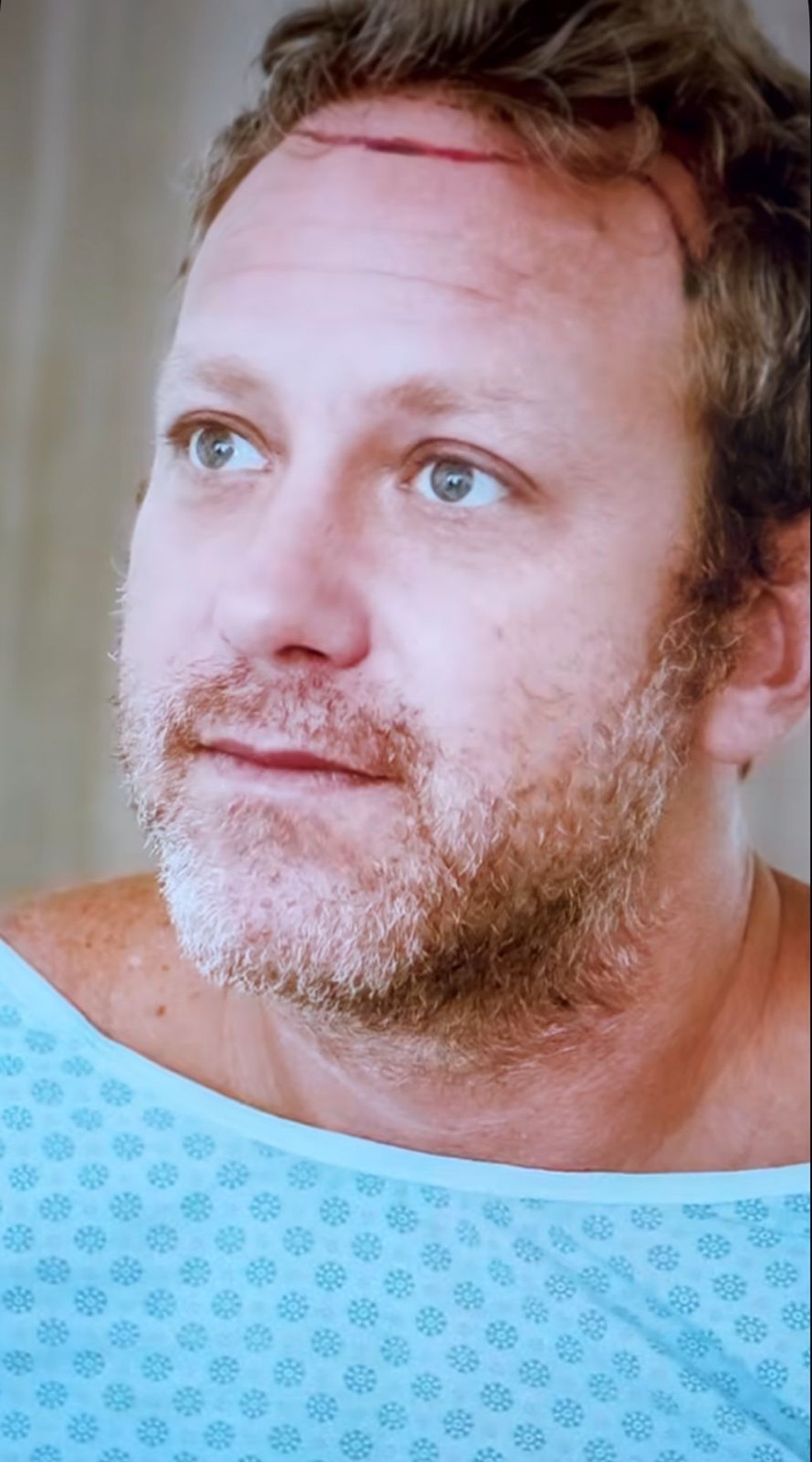 Sergio Hondjakoff faz novo procedimento de transplante capilar &mdash; Foto: Reprodu&ccedil;&atilde;o/Instagram