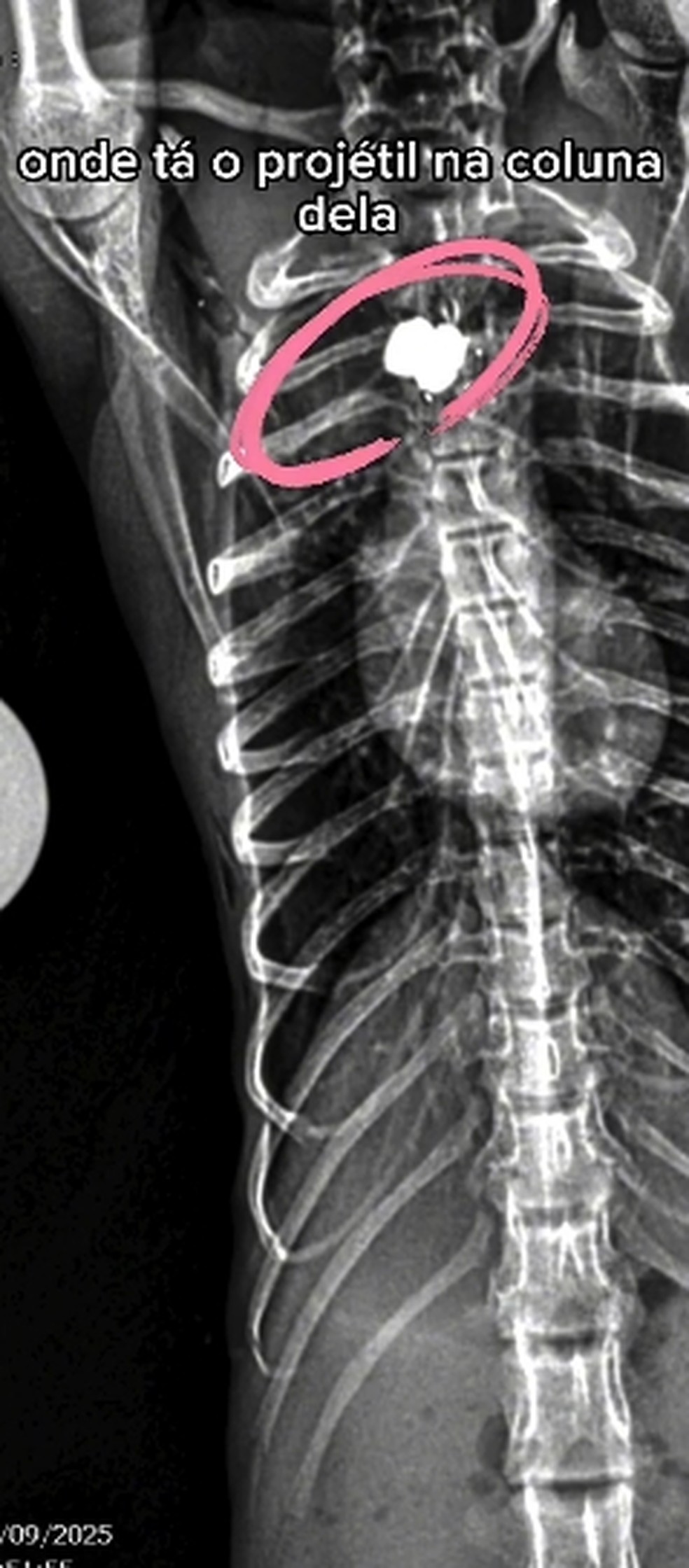 Onde o proj&eacute;til acertou Maria &mdash; Foto: Reprodu&ccedil;&atilde;o/ Instituto Vida Livre