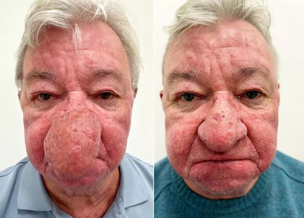 Gerard McAliece antes e depois da cirurgia para tratar rinofima — Foto: Reprodução/Ever Clinic