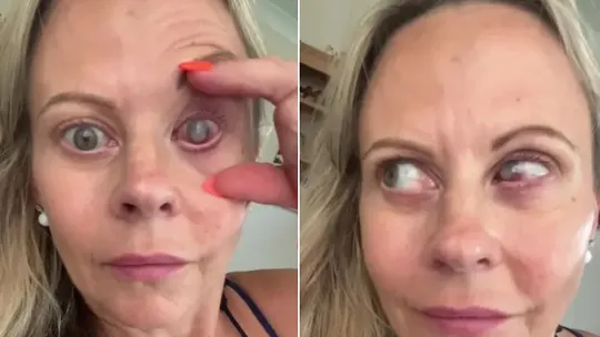 Britânica vive pesadelo após parasita devorar uma córnea, em caso raro Britânica vive pesadelo após parasita devorar uma córnea, em caso raro