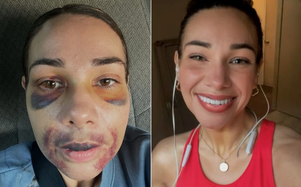 Lacey Duvall durante a recupera&ccedil;&atilde;o e com o sorriso novo &mdash; Foto: Reprodu&ccedil;&atilde;o