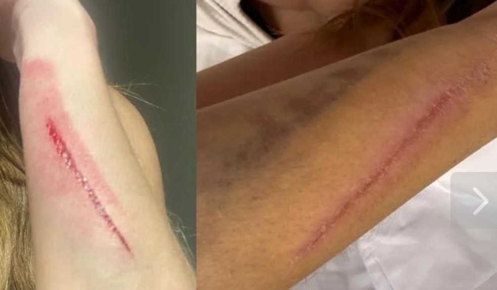 Veja fotos da agressão que Maria Melilo, campeã do 'BBB 11', teria sofrido do namorado — Foto: Reprodução