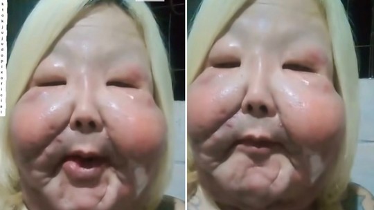 Influenciadora Juju do Pix é submetida a nova cirurgia facial após complicação