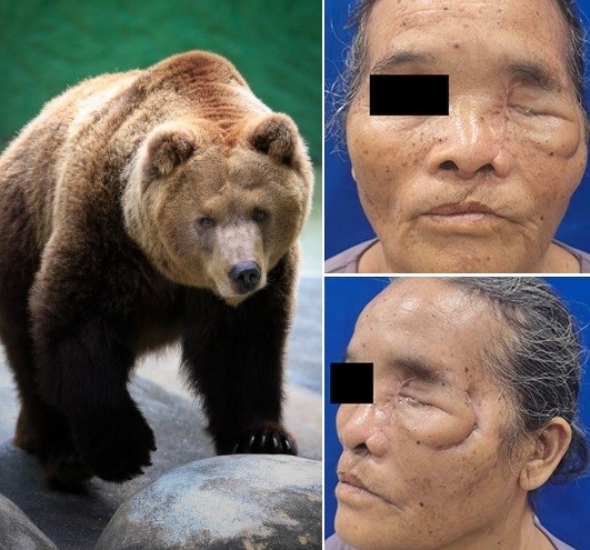 Idosa é atacada por urso e tem metade do rosto desfigurada