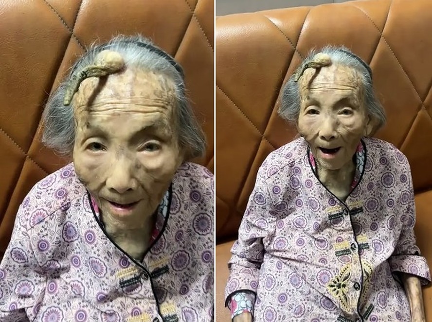Idosa de 107 Anos com Chifre na Cabeça