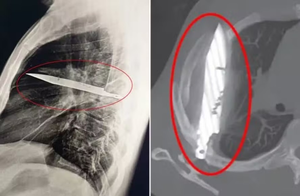 Homem reclama de dores nos mamilos, e m&eacute;dico descobre l&acirc;mina de faca alojada no seu corpo h&aacute; oito anos &mdash; Foto: Reprodu&ccedil;&atilde;o/Journal of Surgical Case Reports