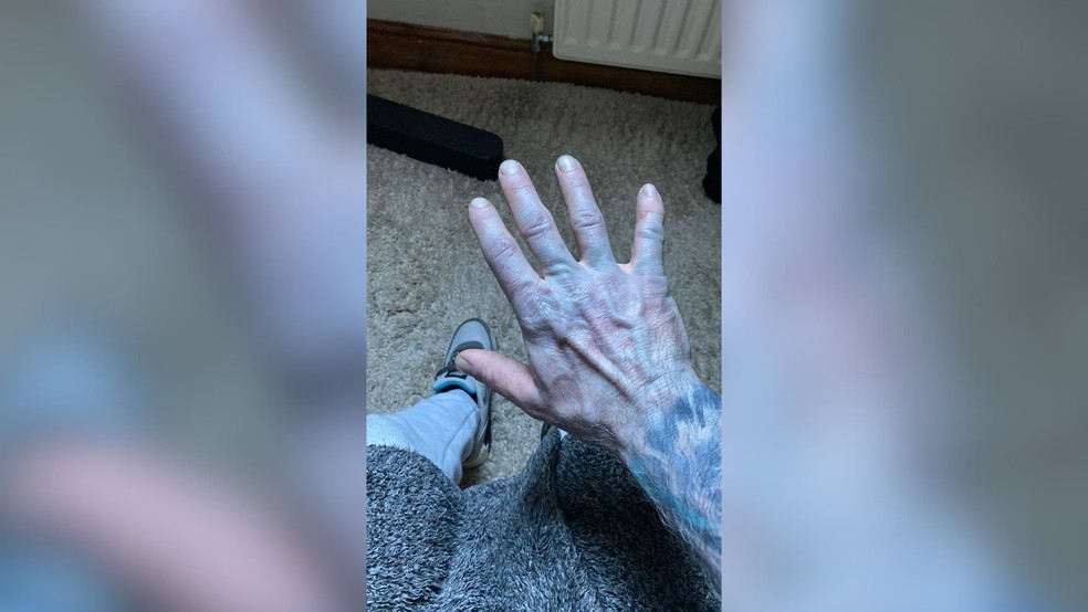 Mão de Tommy, com aspecto azulado, depois de uma noite mal dormida e um "tingimento" surpresa causado pelo próprio edredom — Foto: Reprodução/Facebook