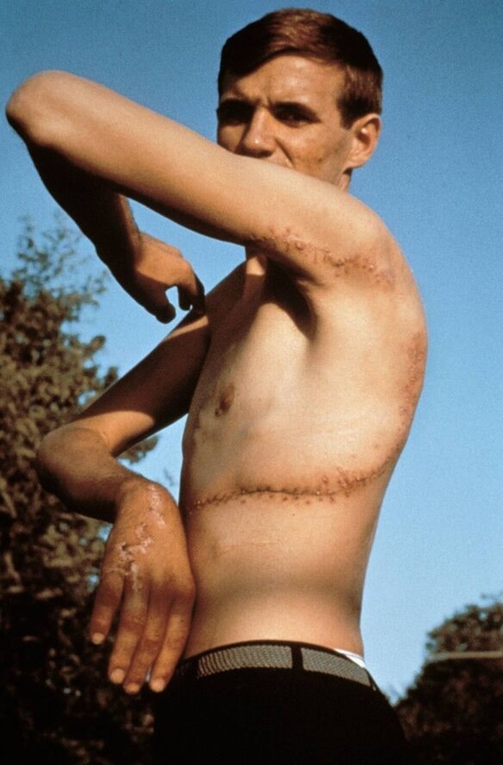 Rodney Fox e seus ferimentos após o ataque em 1963 — Foto: Reprodução/Internet