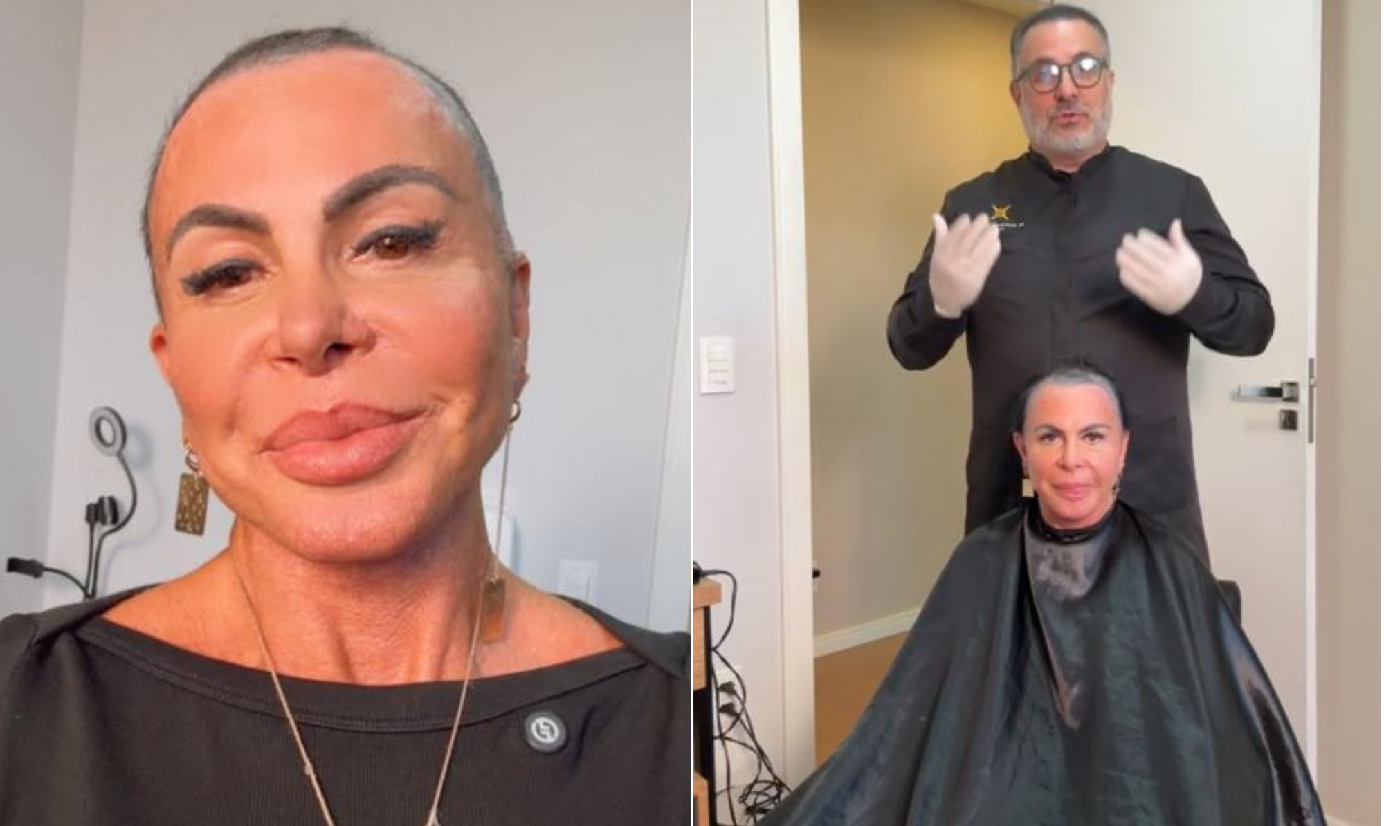 Gretchen raspa a cabeça para transplante capilar e expõe alopecia: 