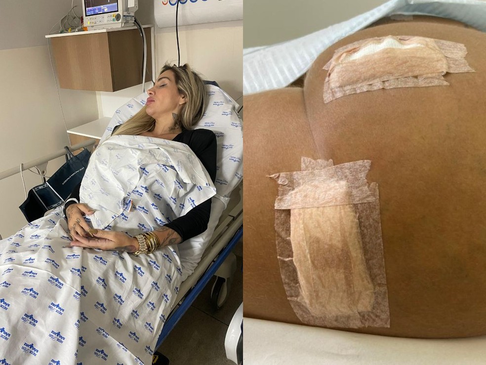 Juju Ferrari mostra como ficou o bumbum após infecção por hidrogel — Foto: Arquivo pessoal