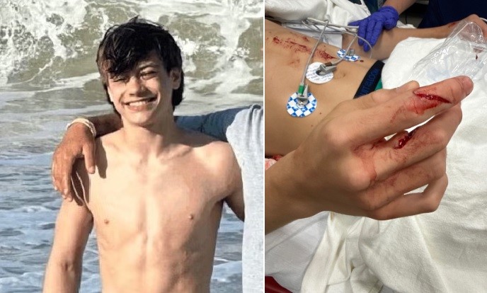 Em episódio raro, adolescente é atacado por castor com raiva quando nadava em lago