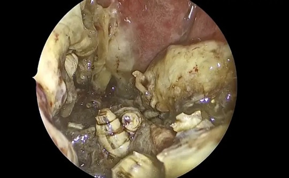 Médico observa larvas de inseto no nariz de paciente nos EUA — Foto: Reprodução