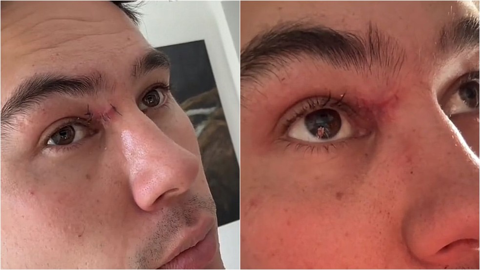 Kai Davidson mostra o resultado da cirurgia de remo&ccedil;&atilde;o do cisto: 'cicatriz pelo resto da vida' &mdash; Foto: Reprodu&ccedil;&atilde;o/TikTok