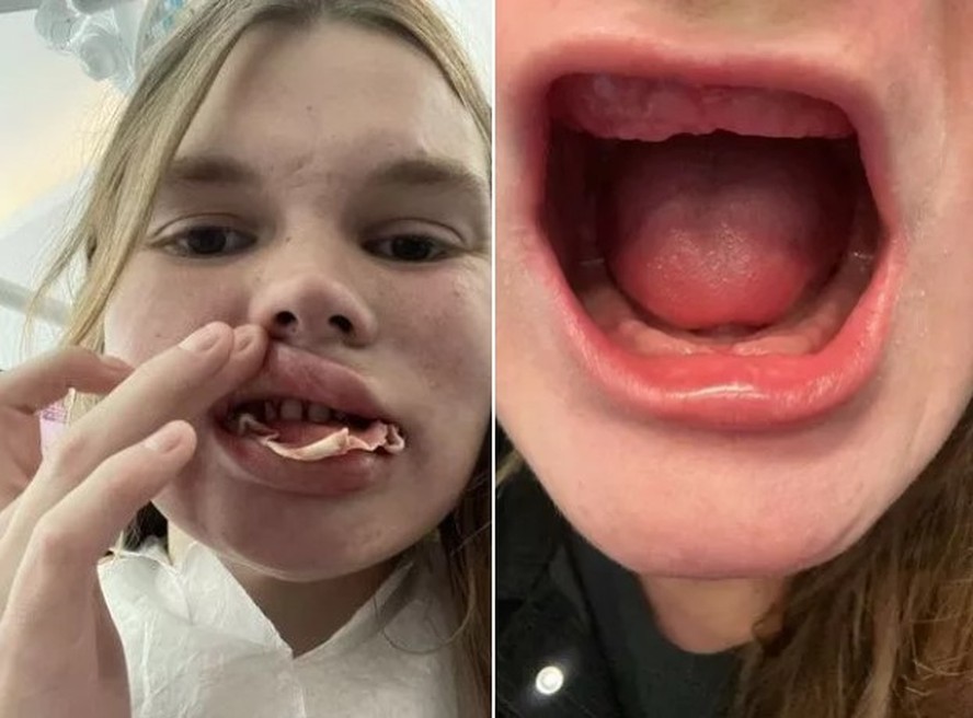 Mulher perde todos os dentes ap&oacute;s tratamento 'barato' na Turquia se tornar um 'fracasso total'