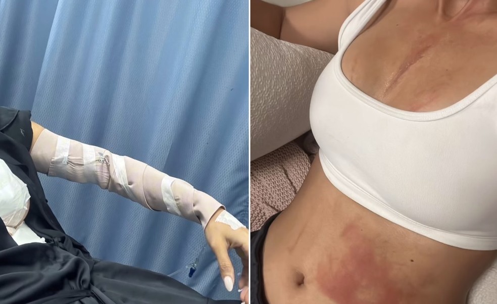 Debbie Aflalo, ex-miss e modelo, sofreu queimaduras ap&oacute;s panela de press&atilde;o estourar &mdash; Foto: Reprodu&ccedil;&atilde;o/Instagram