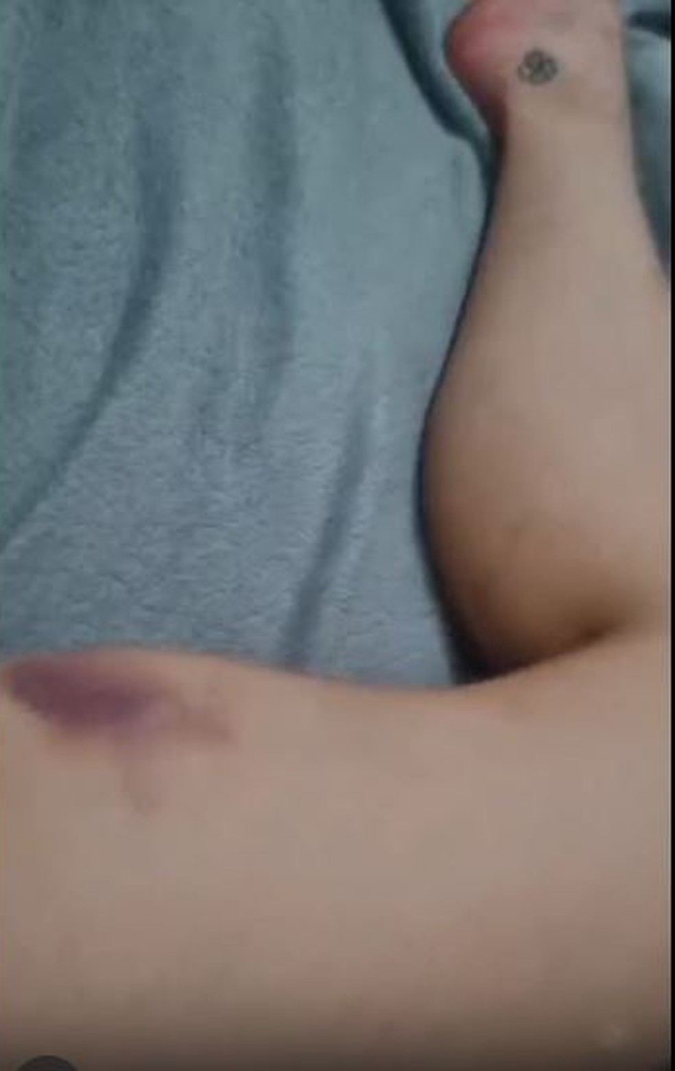 Advogada Larissa Ferrari mostrou hematomas pelo corpo ao acusar Dimitri Payet, do Vasco, de agressão — Foto: Arquivo pessoal