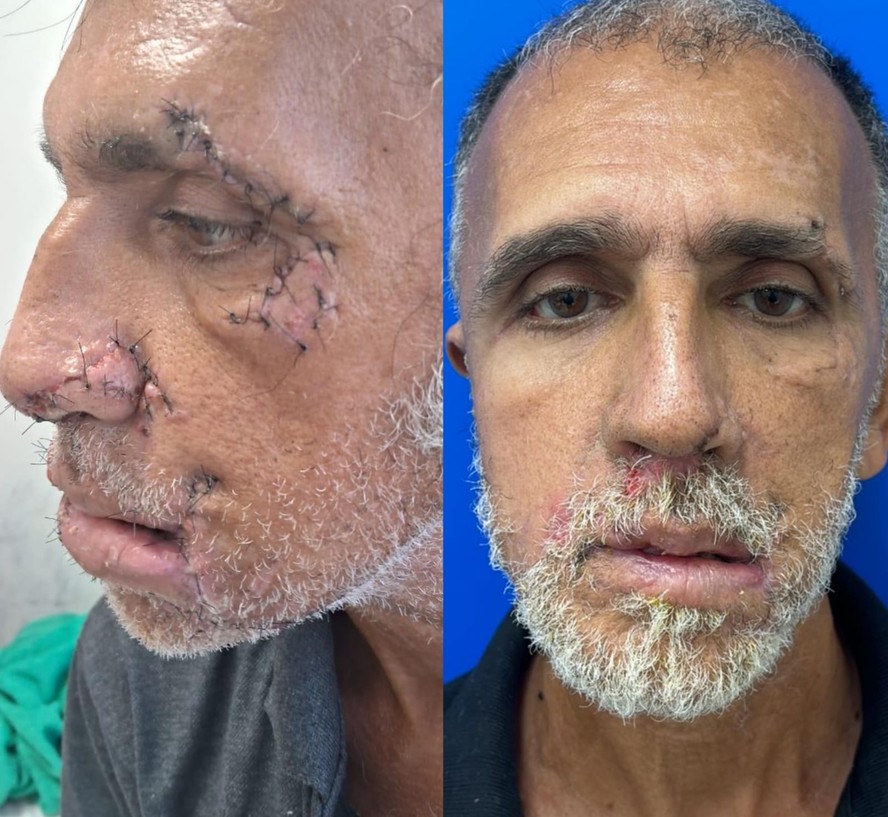 Catador sobrevive após ser atacado por dois pitbulls na Baixada Fluminense