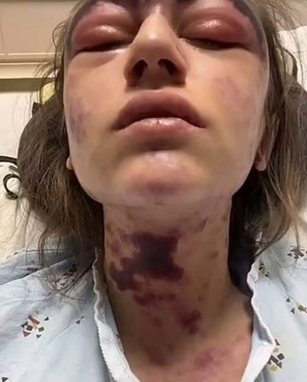 Alexis Lorenze, depois de reação no tratamento para condição sanguínea rara — Foto: Reprodução/TikTok