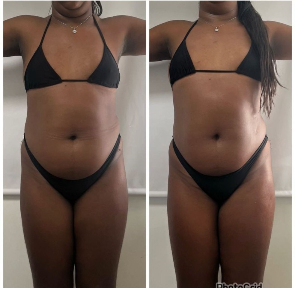 Raquel Brito mostra antes e depois de procedimento — Foto: Instagram