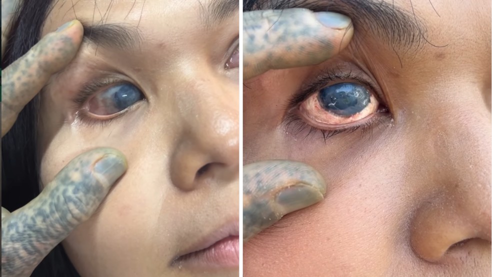 Antes e depois do procedimento de "pintura" do globo ocular da tailandesa Amorn &mdash; Foto: Divulga&ccedil;&atilde;o: lily_lu_filmz