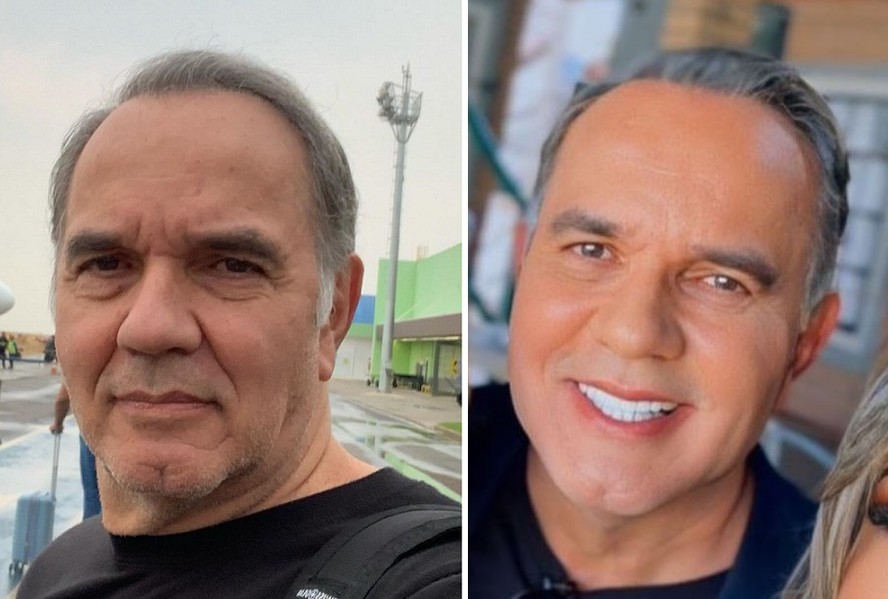 Humberto Martins faz harmonização facial