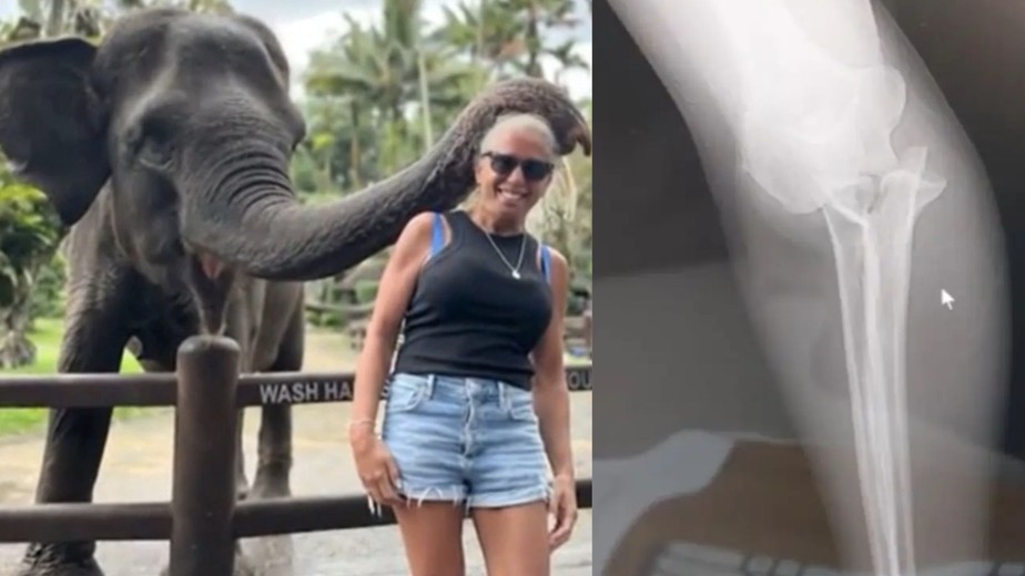 Turista tem braço mordido por elefante em viagem para Bali: 'Estalo dos  ossos me deixou em pânico