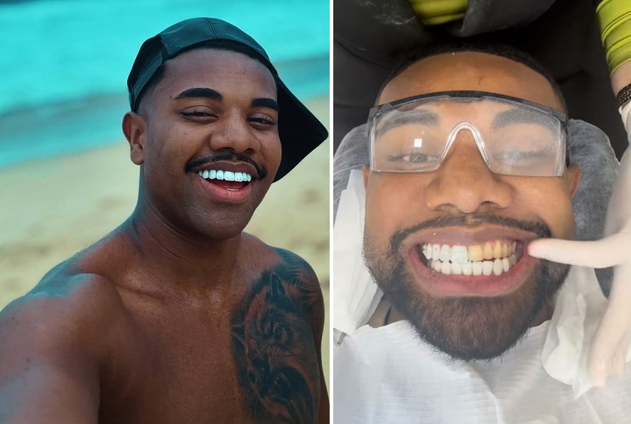 Após críticas, Davi Brito se arrepende e troca lentes de contato dos dentes