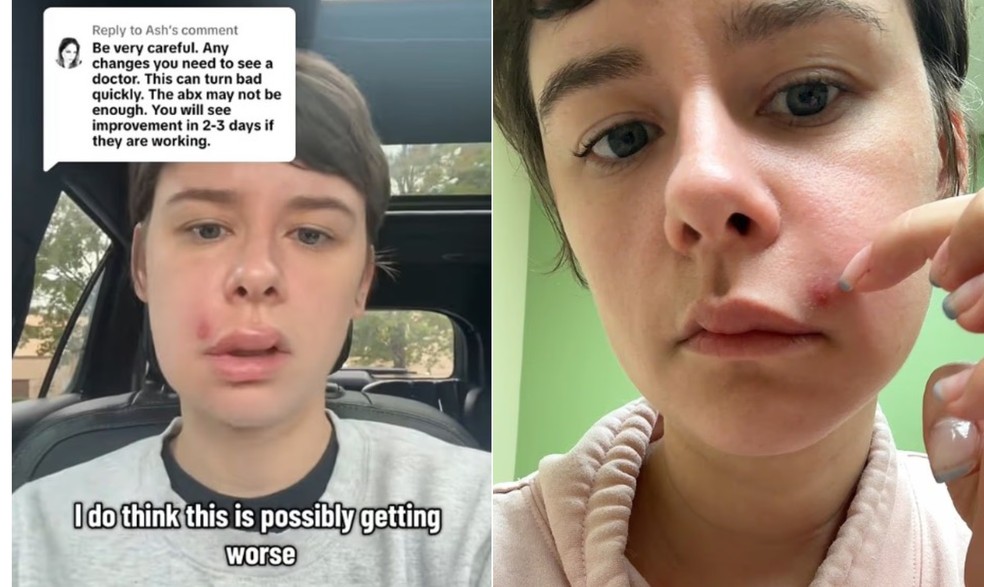 Lindsay deOliveira foi hospitalizada após espremer uma espinha no "triângulo da morte" — Foto: Reprodução/Tiktok