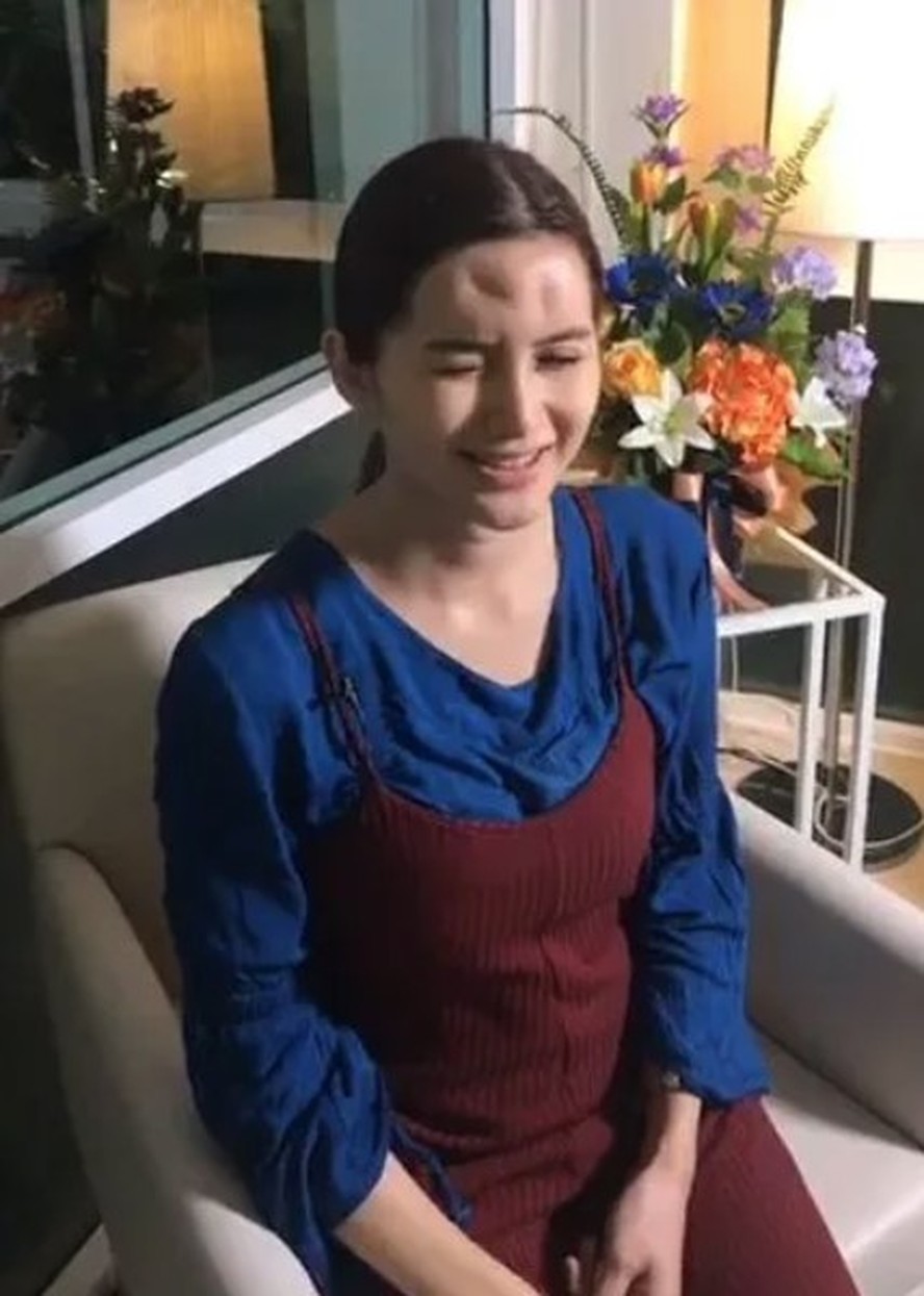 Nong Guang após ter preenchimento removido da testa