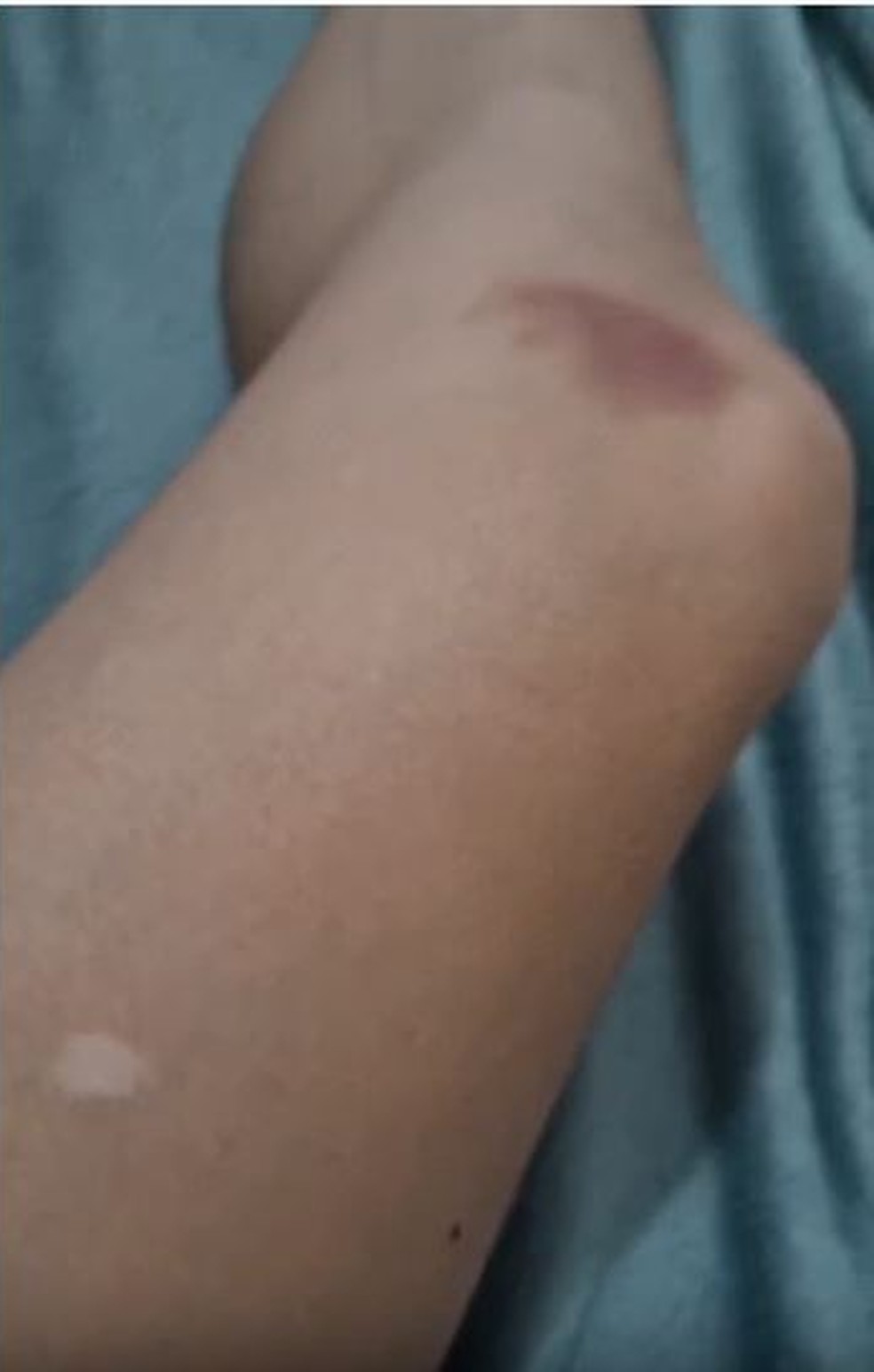 Advogada Larissa Ferrari mostrou hematomas pelo corpo ao acusar Dimitri Payet, do Vasco, de agressão — Foto: Arquivo pessoal