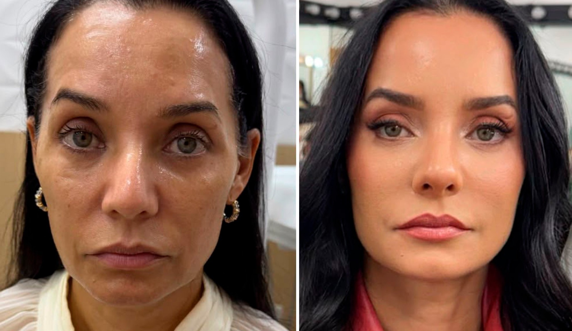 Atriz Mônica Carvalho passa por harmonização facial: veja antes e depois