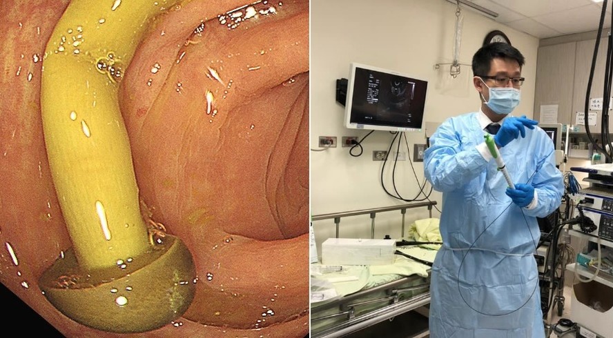 Médico Lin Xianghong descobriu cogumelo crescendo no intestino de paciente em Taiwan