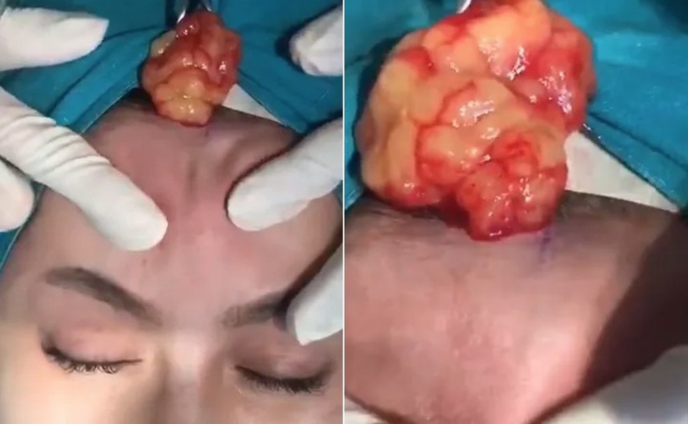 Na Tailândia, mulher ter preenchimento removido da testa após infecção — Foto: Reprodução