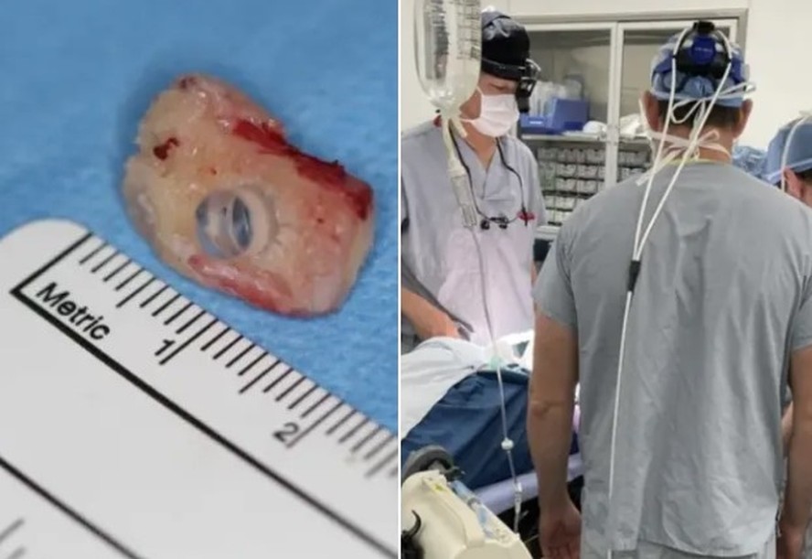 Paciente canadense deve voltar a enxergar após ter dente implantado em bochecha
