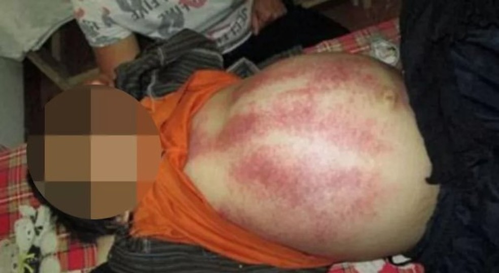 Pacient de Xiao na Austr&aacute;lia coberto de marcas de tapas &mdash; Foto: Reprodu&ccedil;&atilde;o
