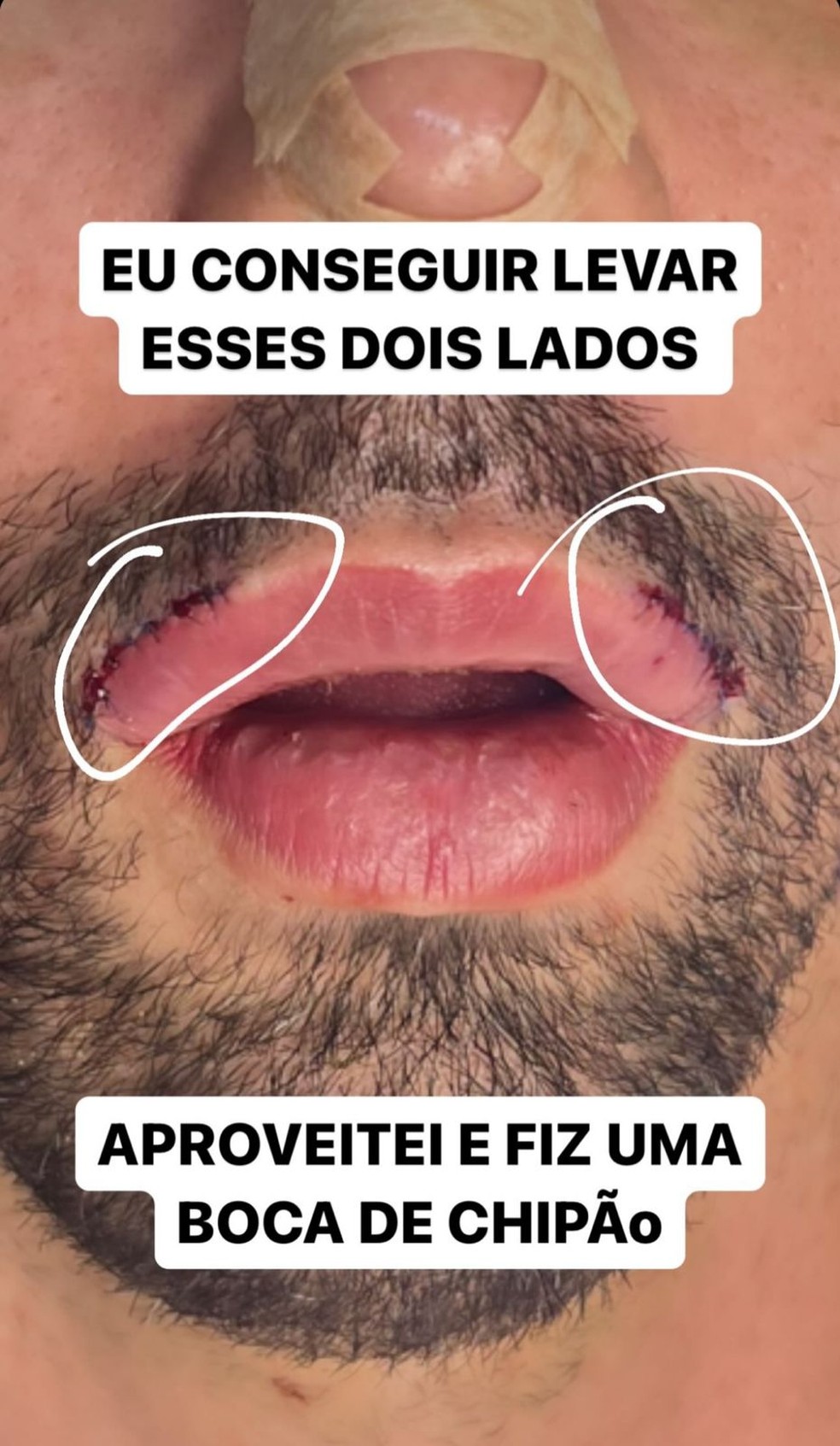 Rico Melquíades desabafa após cirurgia no rosto — Foto: Instagram