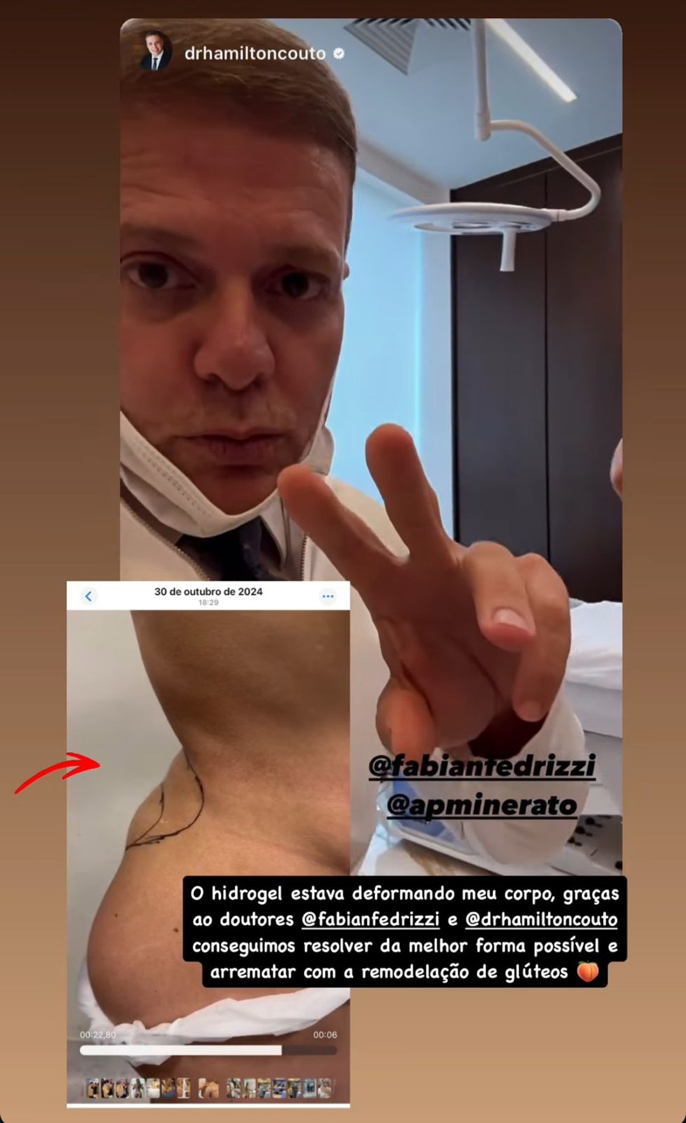 Ana Paula Minerato retira hidrogel do bumbum após complicações — Foto: Instagram