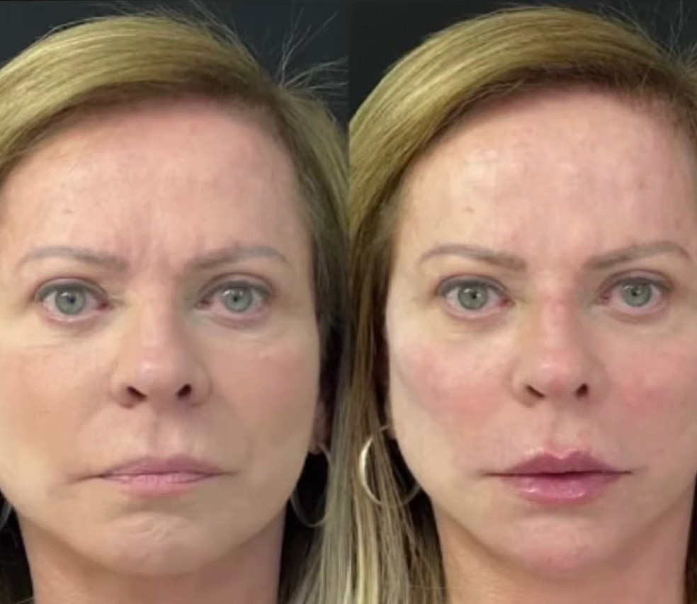 Chistina Rocha passou recentemente por uma harmonização facial — Foto: Reprodução/Instagram