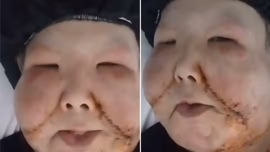 Juju do Pix celebra sucesso em nova cirurgia para remoção de óleo mineral do rosto: 'Do jeito que eu queria'