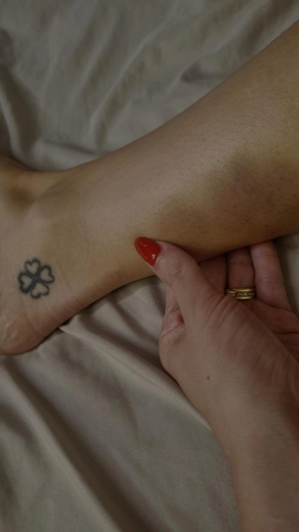 Advogada Larissa Ferrari mostrou hematomas pelo corpo ao acusar Dimitri Payet, do Vasco, de agressão — Foto: Arquivo pessoal