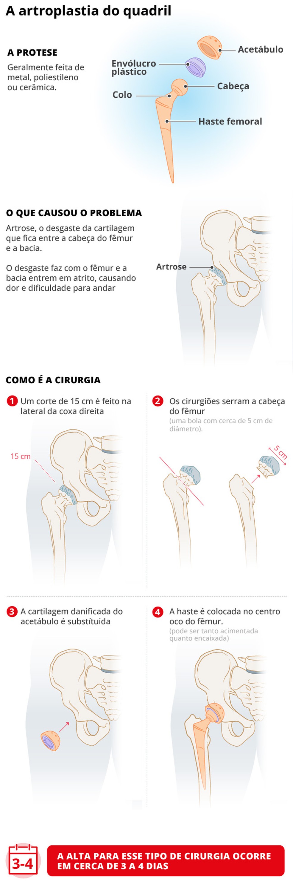 Infográfico mostra como será a cirurgia de quadril de Lula — Foto: Editoria de Arte