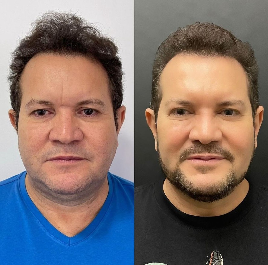 Ximbinha mostra antes e depois de cirurgia facial — Foto: Instagram