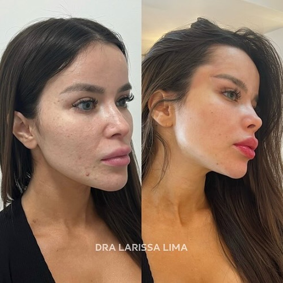 Namorada de Ângelo Gabriel, ex-Santos, Bianca Anchieta fez harmonização facial — Foto: Reprodução/Instagram
