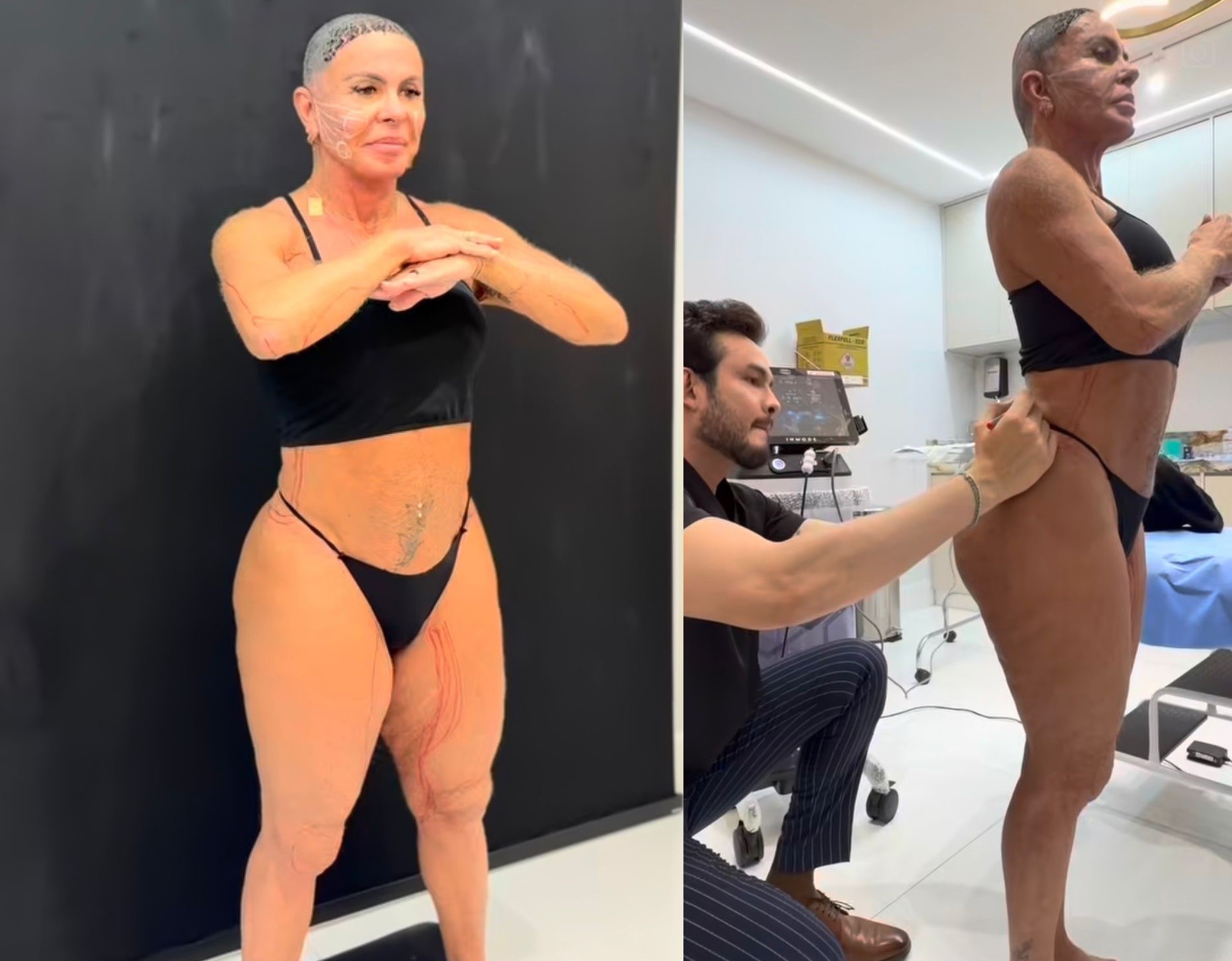 Gretchen mostra tratamento contra flacidez no rosto, pernas e bumbum: ‘Ficando incrível’ - QTU Questões do Universo