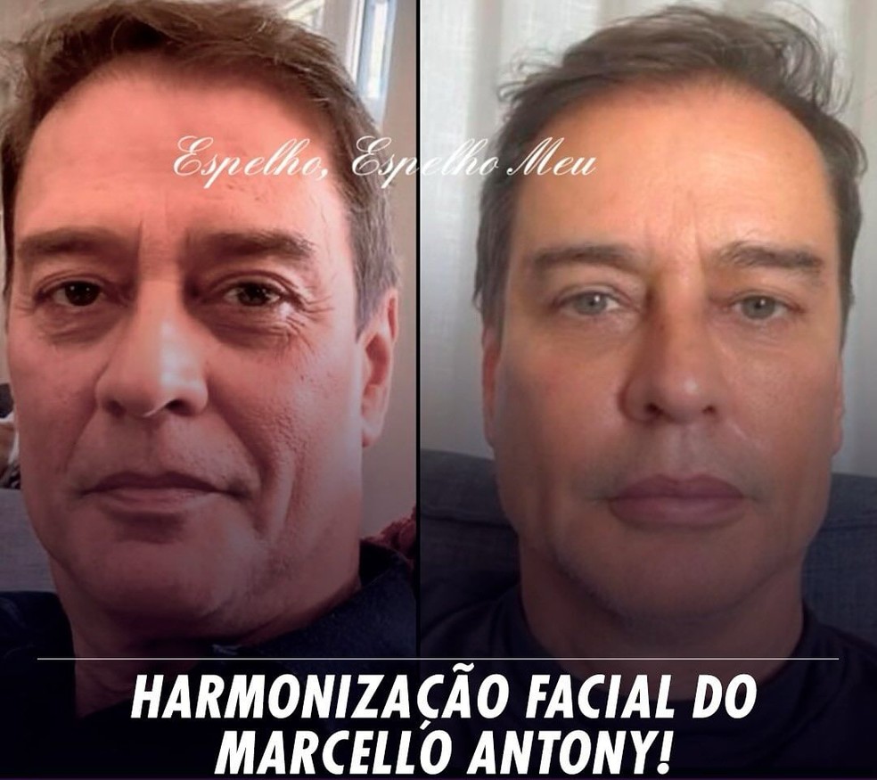 Marcello Antony faz harmoniza&ccedil;&atilde;o facial &mdash; Foto: Reprodu&ccedil;&atilde;o/Instagram
