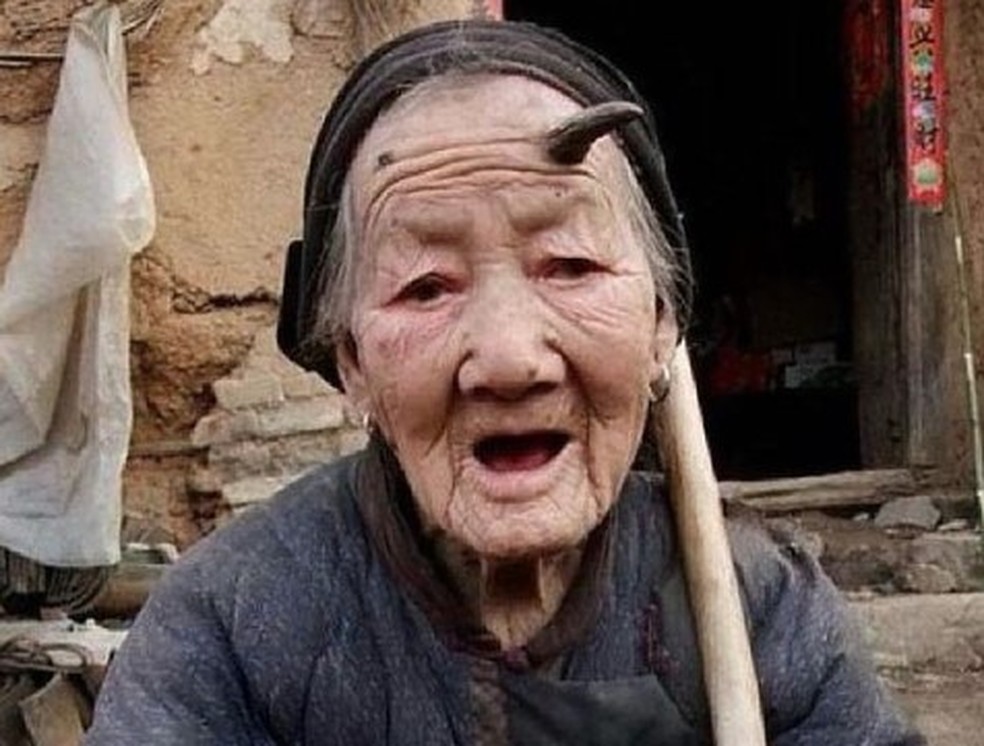 Chinesa Zhang Ruifang teve dois 'chifres' crescendo na testa — Foto: Reprodução/Instagram