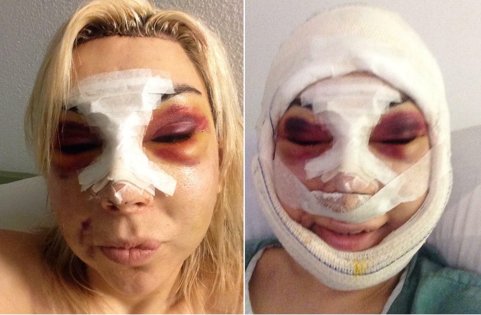 Cantora trans portuguesa Patrícia Ribeiro se arrepende de silicone industrial — Foto: Arquivo pessoal