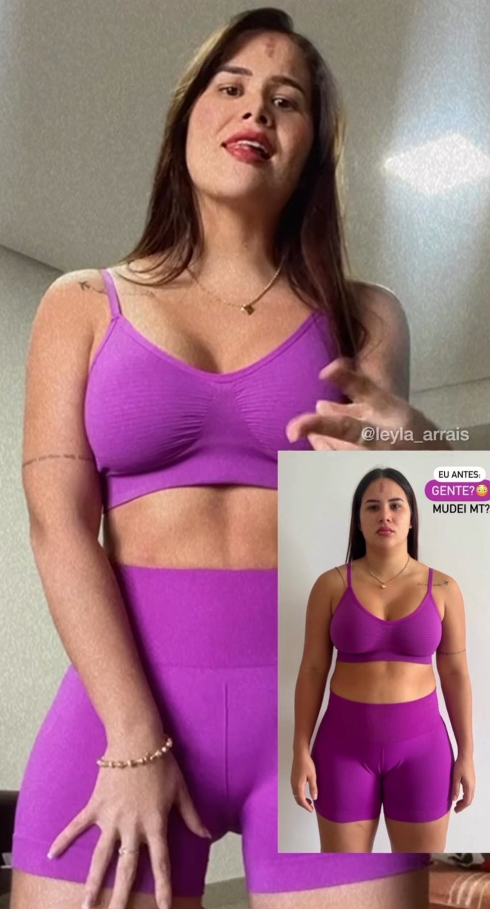 Influenciadora cria polêmica ao mostrar resultado de cirurgia íntima — Foto: Instagram